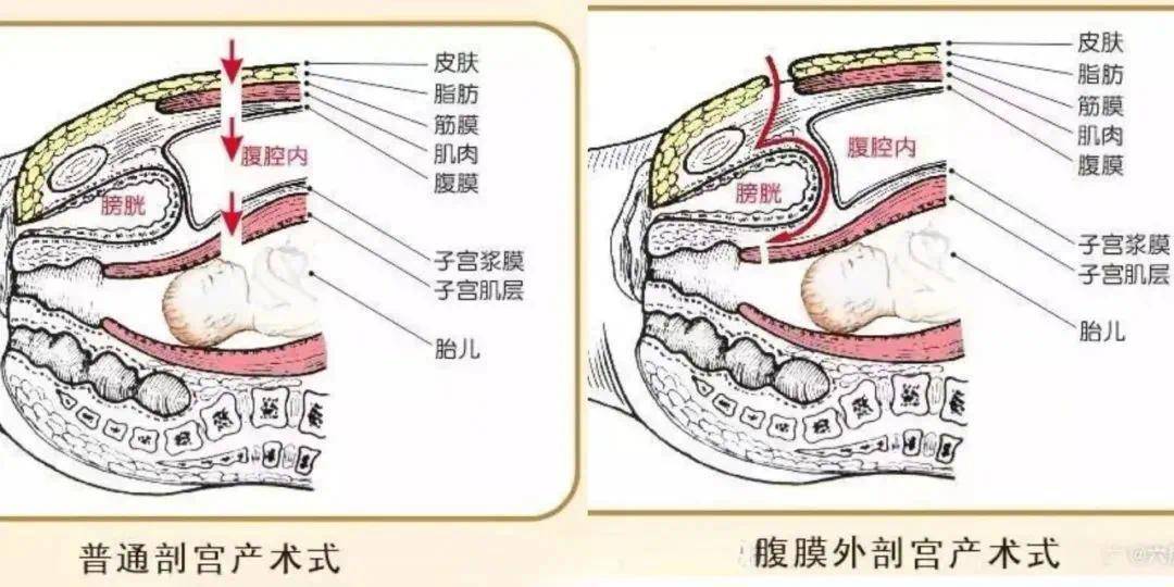 術中把腹膜及膀胱頂部,部分膀胱後壁與子宮前壁下段分離開來再切開