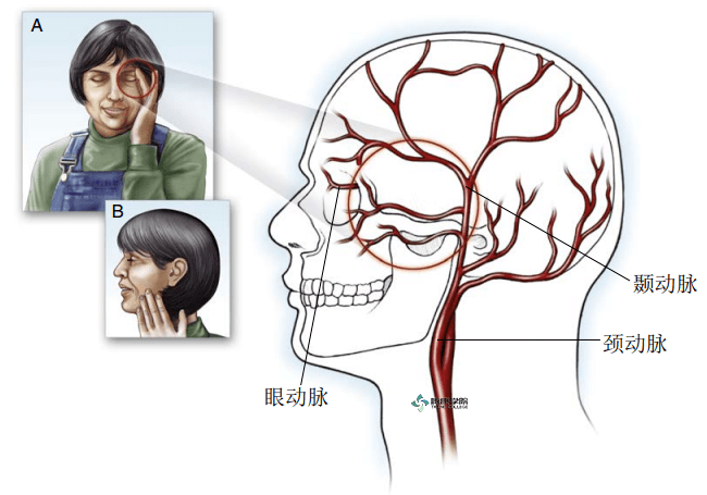 颞动脉位置图片图片