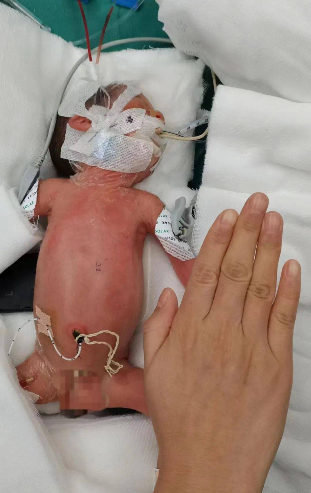 33周生下来的胎儿图图片