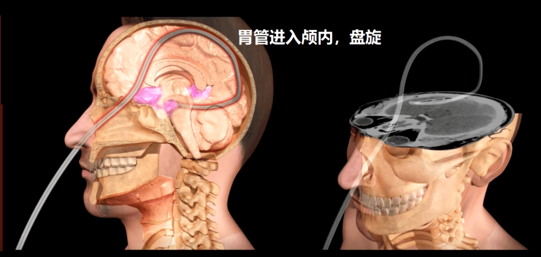 進入大腦的,就好像這樣:很明顯,病人由於鞍區長