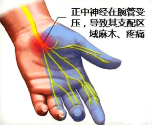 手指麻木,夜間痛醒,小心腕管綜合徵_患者_手術_治療