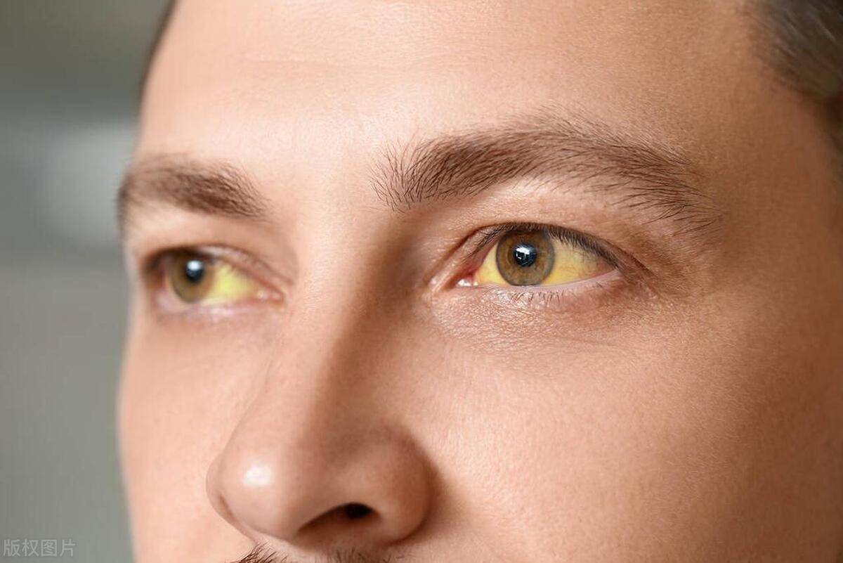 1,黄皮肤和黄眼睛(黄疸)值得注意的是,肝脏疾病也并非总是在早期症状